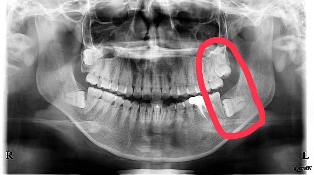 g_eneglaer's tweet image. รีวิวผ่าฟันคุดที่คลินิกนอกเวลาของมธ. จองพฤหัสได้ผ่าเสาร์เลย คิวเร็วมาก ตอนเอาฟิล์มไปให้อ.หมอก็กลัวๆเพราะคลินิกบอกฟันมันลึกให้ไปหาหมอศัลย์ สรุปอ.หมอบอกทำได้ ไม่เกิน 30 นาที!!! ตกลงทำ 2 ซี่บนล่างซ้าย ออกมาจริงประมาณ 20 นาที!! เร็วมากกกก…