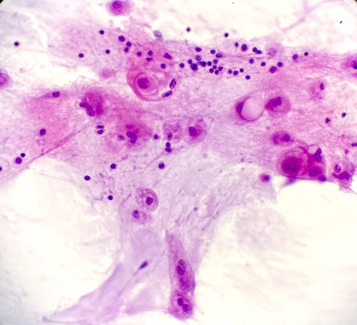 Beauty can be defined by the appearance of a chordoma in cytology 😍 #frozen #Cytology #PathX <a href="/UMiamiPathology/">UMiami Pathology</a>