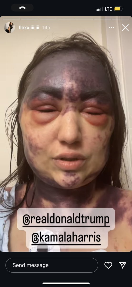 yourNEWS_com's tweet photo. 23 year old, Alexis Lorenze, went to UCI Irvine Medical hospital to get treatment for symptoms of a blood disorder she was recently diagnosed with. The hospital allegedly refused to treat her unless she got the polio, meningitis and pneumonia vaccine all at once. https://t.co/JXOC3t1Fac