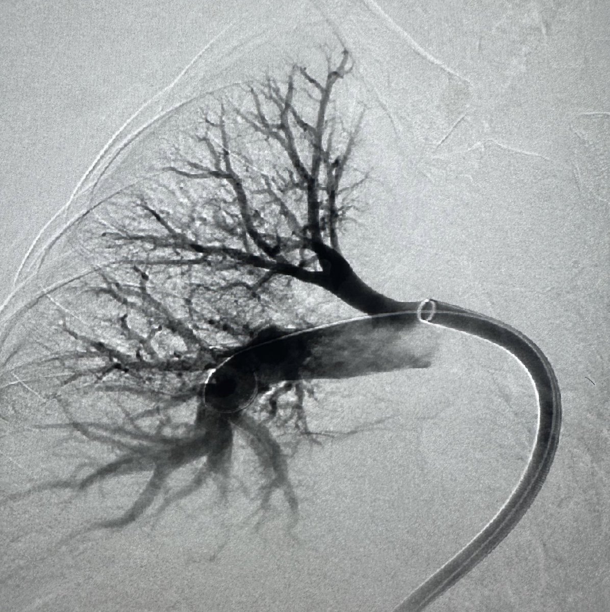 5 submassive PEs requiring thrombectomy in a single day during my last weekend call! #iRad