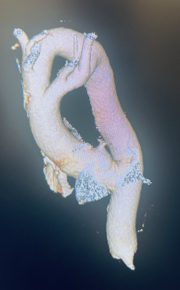 I may be biased but in my world everyone has congenital heart disease until proven otherwise. Here is a middle aged adult with aspiration and “asthma”. The had a previously undiagnosed double arch leading to obstruction of the trachea/esophagus. #ACHD ❤️‍🩹