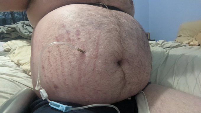 Decided to do an extended N2O blimp session. Tied off my chest and my waist https://t.co/xsgKcokiWH