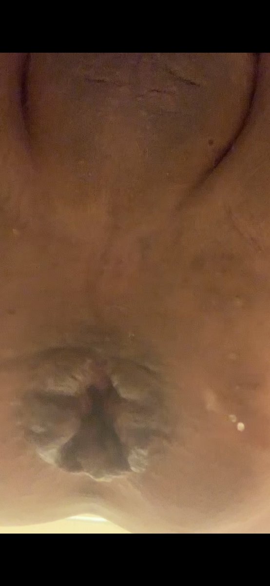 sissycumslutCC3's tweet photo. Oh my fucking god it looks like itโs gunna fall out doesnt it?! #prolapse #loosefag #loosesissy #gaped #stretched #cunted #broken #loose #wornout #trained https://t.co/VRkKWeasbA