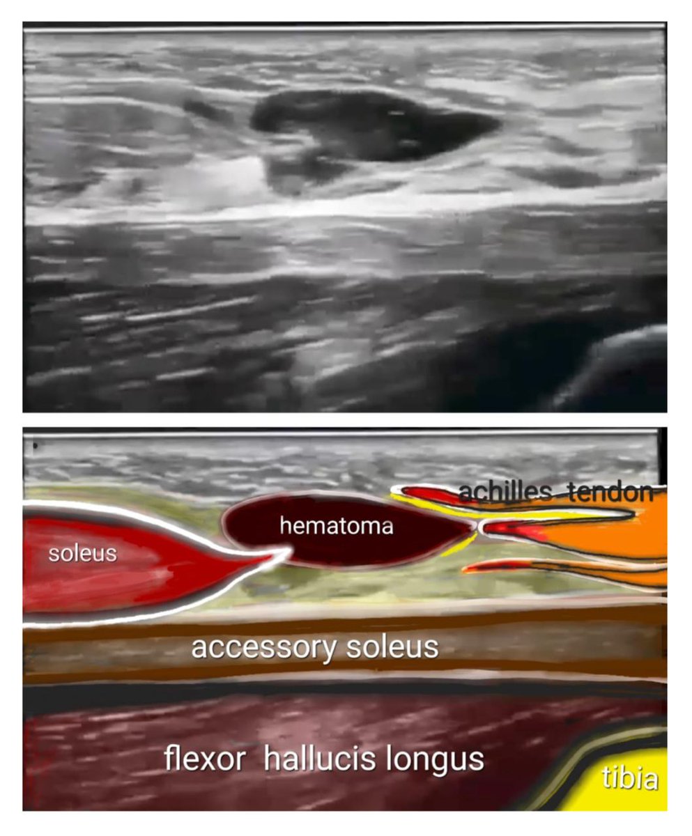 soleus myotendinous junction tear
Note made of accessory soleus 🧐😴