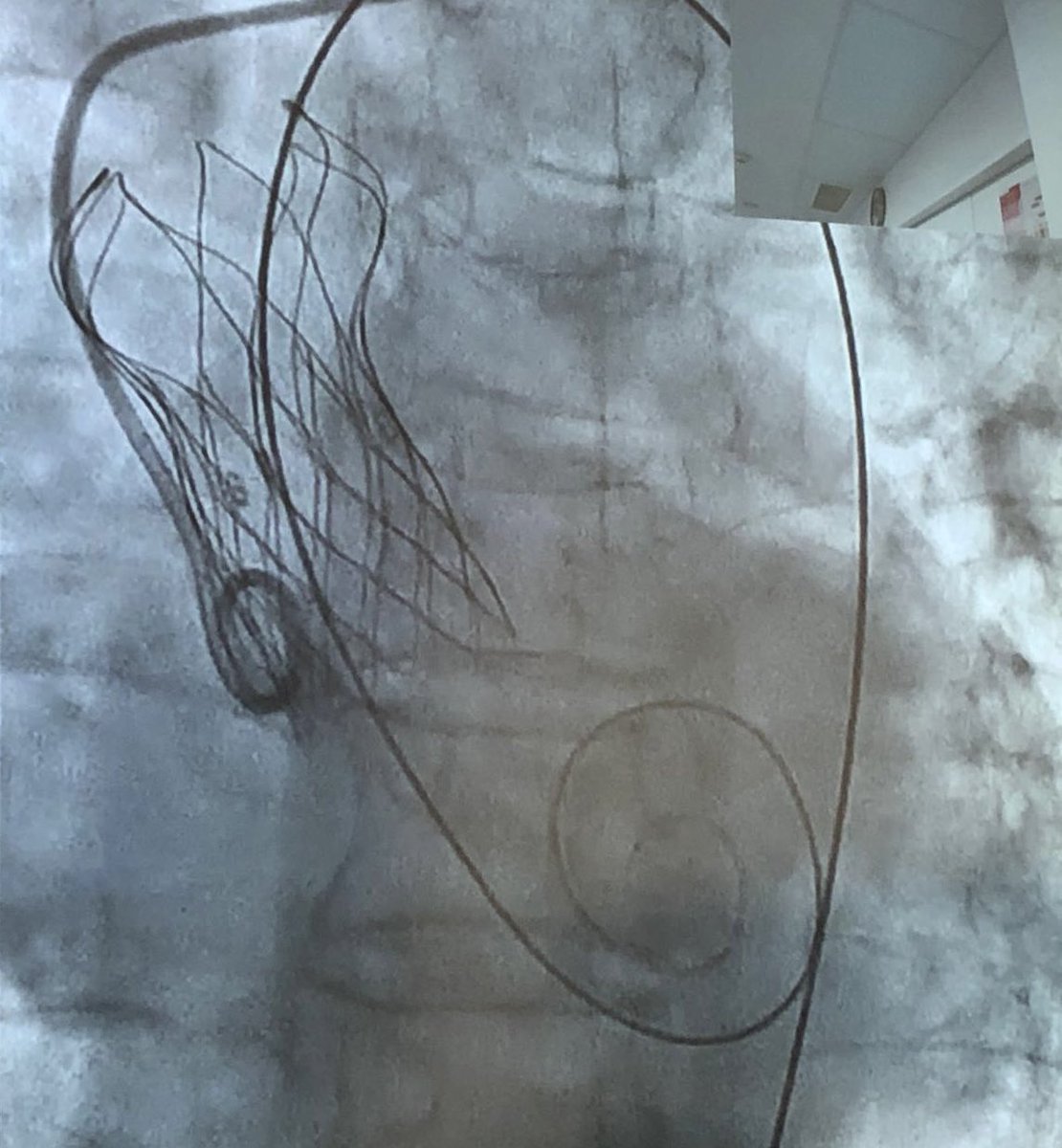 Ignacio J. Amat (@ignamatsant) on Twitter photo First 3 Vitaflow cases in Spain.
Robotic release, super-stable positioning, no PVL & no conduction disturbances. Great initial sensations w help from my friend <a href="/msztejfman/">Matias Sztejfman</a>
<a href="/Carlos_Cortes_V/">Carlos Cortés</a> <a href="/Sara_Blasco/">Sara Blasco Turrión</a> <a href="/mariogago13/">Mario García Gómez</a> <a href="/ClaraFdezCordon/">Clara Fernández Cordón</a> <a href="/shci_sec/">ACI-SEC: Hemodinamica</a> <a href="/PCRonline/">PCRonline 🫀</a> <a href="/dmylotte/">Darren Mylotte</a> <a href="/solaci_online/">SOLACI</a> First 3 Vitaflow cases in Spain.
Robotic release, super-stable positioning, no PVL & no conduction disturbances. Great initial sensations w help from my friend <a href="/msztejfman/">Matias Sztejfman</a>
<a href="/Carlos_Cortes_V/">Carlos Cortés</a> <a href="/Sara_Blasco/">Sara Blasco Turrión</a> <a href="/mariogago13/">Mario García Gómez</a> <a href="/ClaraFdezCordon/">Clara Fernández Cordón</a> <a href="/shci_sec/">ACI-SEC: Hemodinamica</a> <a href="/PCRonline/">PCRonline 🫀</a> <a href="/dmylotte/">Darren Mylotte</a> <a href="/solaci_online/">SOLACI</a>
