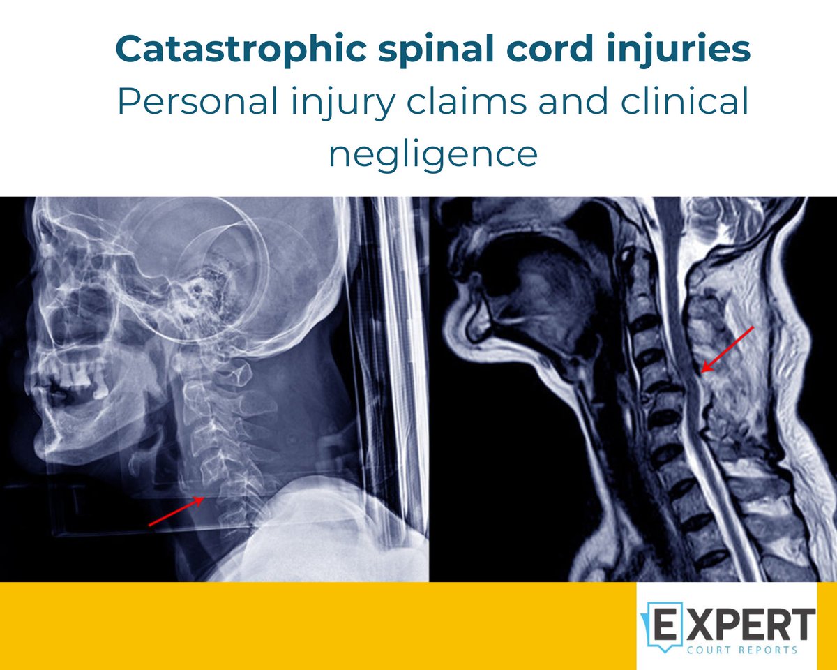 An injury is considered “catastrophic” when it leaves the victim with life-changing, and long-term consequences. 

At Expert Court Reports, we have several experts who may provide expert evidence in claims arising from spinal injuries.