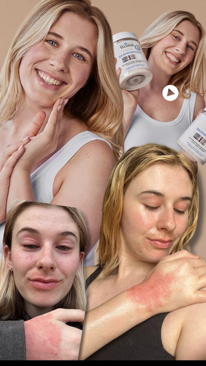 🥹😭 I am SO proud to be a part of the new #ShareYourFlare campaign with <a href="/westlabsalts/">@westlabsalts</a> 🧂❤️‍🩹

instagram.com/p/DAByGs4oyzd/