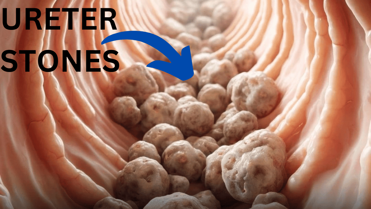 Glowwellguru's tweet photo. Have you ever felt a sudden sharp pain in your lower back or side that made you stop in your tracks?
What if I told you that pain might be caused by something as tiny as a grain of sand? Ureter stones!
#KidneyDisease #ureter #Health #Chosen https://t.co/szD39kYxsI