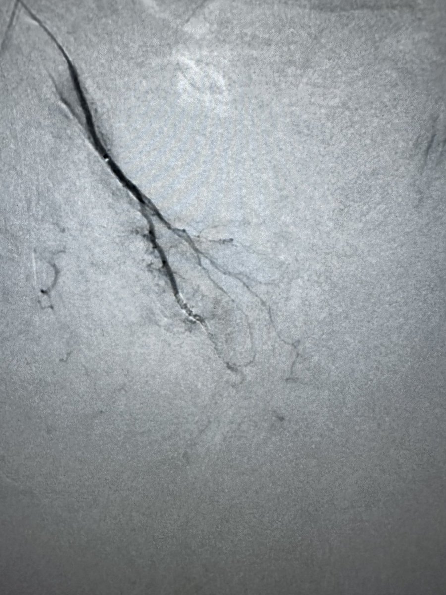 Prostatic artery embolization (PAE) is a game-changer for men with benign prostatic hyperplasia (BPH)! A minimally invasive procedure that reduces prostate size, improves urinary symptoms, can promote a faster recovery compared to traditional surgery. #BPH #MenHealth #PAE