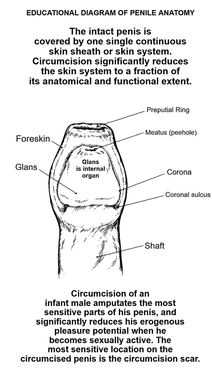 BloodstainedMen's tweet image. "THE TRIPLE WHAMMY" by Francisco Garcia The circumcised penis loses sensitivity in three ways: 1. Loss of the foreskin nerves themselves. 2. Damage to the glans. 3. Loss of skin mobility. What exactly is #circumcision and what is it not? cirp.org/library/anatom…