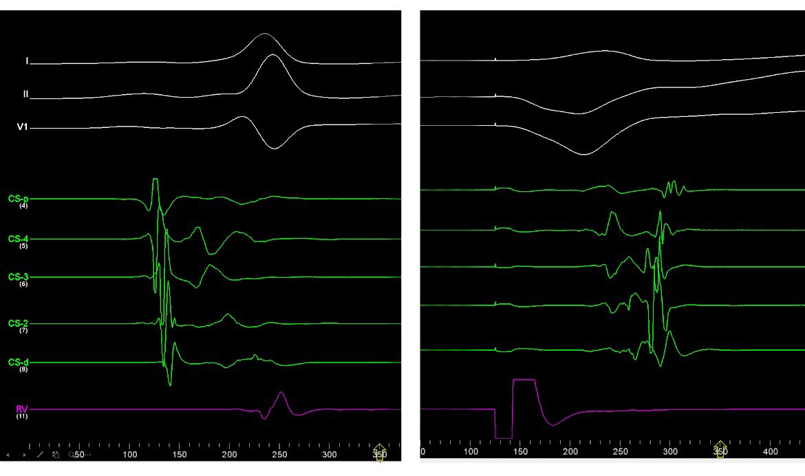 #WPW

Slanted Left posteroseptal AP. Case from last week.

Assessment of oblique course of AP 
during Sinus Rhythm and V pacing.

There is a mismatch in earliest A EGM during V pacing and V far field EGM during Sinus Rhythm.

This will make you know where to aim the RFA.