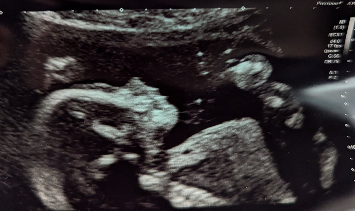Arcanam8's tweet photo. @supersophz &amp; I had our 20 week scan and baby is doing well!
The best news we would like to share is that we are expecting a boy, and we are very excited to meet them soon enough. 
Now begins the task of name selection and getting everything together for when he's finally here ❤️ https://t.co/WHEowNTtTr
