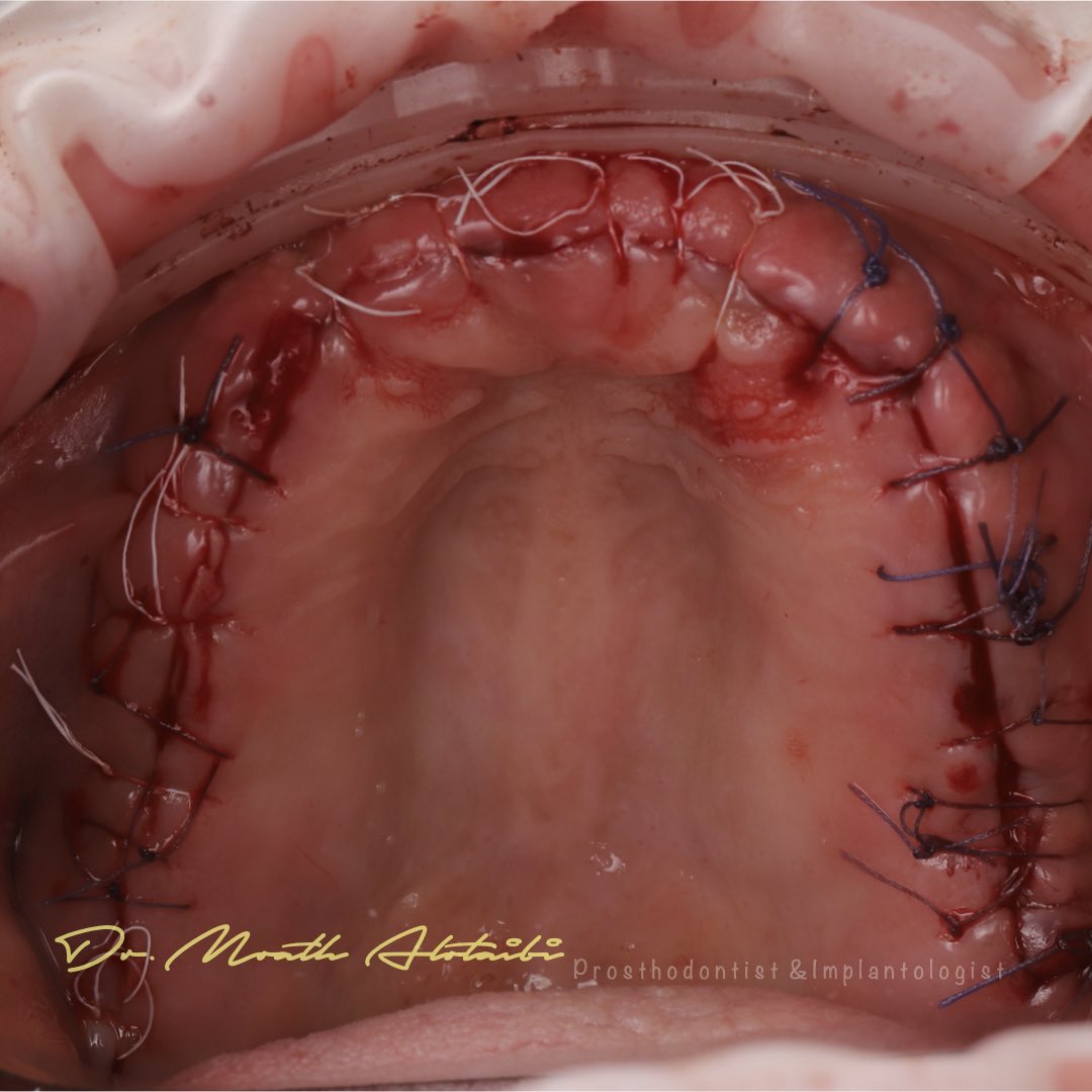 مراجعتي من العقد الرابع من العمر..

تدهورت حالة اسنانها نتيجة حالتها الصحية واستخدامها لبعض الادويه، 

بعد استقرار الحالة، تم تطبيق الخطه العلاجيه:👇🏼
تنظيف الاسنان واللثه
خلع الاسنان والتطعيم العظمي التحفظي  للبعض 
طقم الاسنان الاولي المتحرك
تقييم حالة اللثه والتزام المراجعه