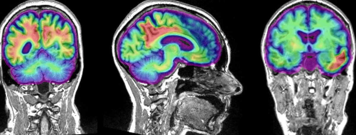 The Neuro (@theneuro_mni) on Twitter photo A new study published in <a href="/NatureNeuro/">Nature Neuroscience</a> by <a href="/sylvain_baillet/">Sylvain Baillet ๐๏ธ</a>'s lab at The Neuro and <a href="/sylv_villeneuve/">Sylvia Villeneuve</a> at <a href="/DouglasResearch/">Douglas Research Centre</a> shows that two Alzheimer's-related proteins impact brain activity differently: From hyper- to hypoactivity to cognitive decline.
buff.ly/3XKUSDY A new study published in <a href="/NatureNeuro/">Nature Neuroscience</a> by <a href="/sylvain_baillet/">Sylvain Baillet ๐๏ธ</a>'s lab at The Neuro and <a href="/sylv_villeneuve/">Sylvia Villeneuve</a> at <a href="/DouglasResearch/">Douglas Research Centre</a> shows that two Alzheimer's-related proteins impact brain activity differently: From hyper- to hypoactivity to cognitive decline.
buff.ly/3XKUSDY