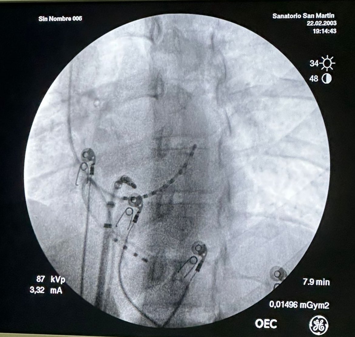 RFA performed close to V insertion mapping the  earliest V during sinus  rhythm at posteroseptal level as depicted in sinus rhythm EGM.

Ablation catheter is not at earliest A during V pacing.

All starts with EGM analysis.

Success at first session.