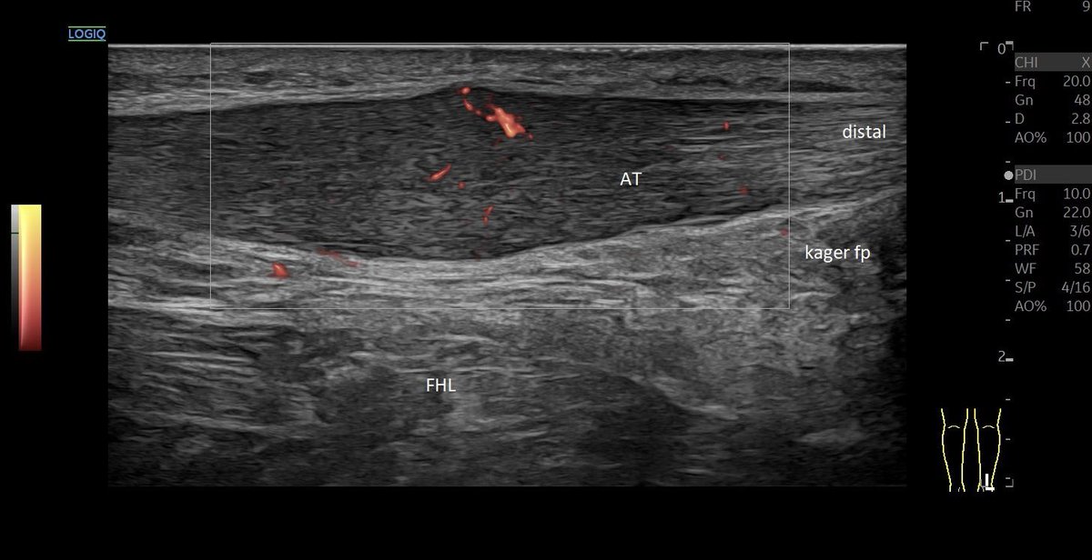 SportklinikBern's tweet photo. Tendinopathy of the #achillestendon with the new GElogoqE10sR4 - #mskus #pocus #pocushub #GElogiqE10sr4 #logiqview #bmode https://t.co/YLyYdxFvlB