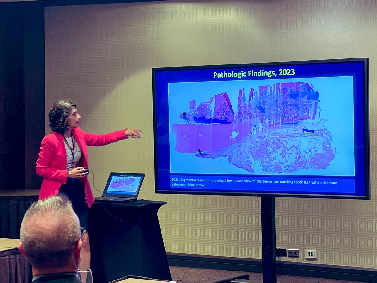 What’s rarer than hens’ teeth?

Low-grade cartilaginous neoplasms of the mandible. 

This tumor masquerading as such on initial biopsy ended up being the *much more common* chondroblastic osteosarcoma. 

Great instructive case <a href="/Nooshin_Dashti/">Nooshin Dashti MD</a> <a href="/reith16/">John Reith</a>

#ISS2024 #BSTPath #ENTPath