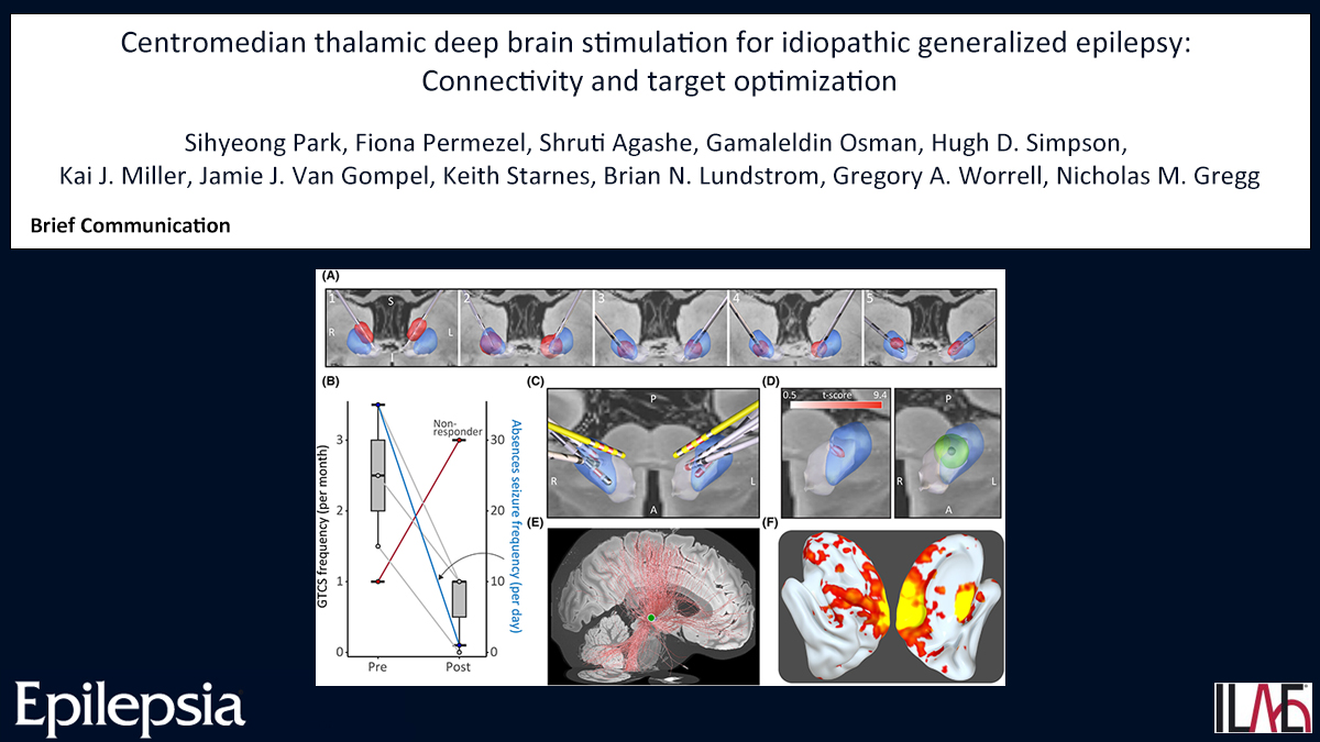 Epilepsia (@epilepsiajourn) on Twitter photo Centromedian thalamic deep brain stimulation for idiopathic generalized epilepsy: Connectivity and target optimization
doi.org/10.1111/epi.18…
#epilepsy #connectivityanalysis #electricalbrainstimulation #neuromodulation #volumetricmapping <a href="/IlaeWeb/">International League Against Epilepsy</a> <a href="/epilepsiajourn/">Epilepsia</a> <a href="/WileyNeuro/">Wiley Neuro</a> Centromedian thalamic deep brain stimulation for idiopathic generalized epilepsy: Connectivity and target optimization
doi.org/10.1111/epi.18…
#epilepsy #connectivityanalysis #electricalbrainstimulation #neuromodulation #volumetricmapping <a href="/IlaeWeb/">International League Against Epilepsy</a> <a href="/epilepsiajourn/">Epilepsia</a> <a href="/WileyNeuro/">Wiley Neuro</a>