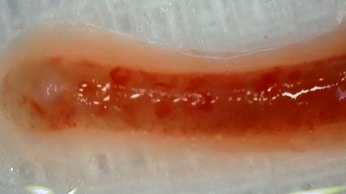 Lillana (@lillana1028) on Twitter photo Biopsia renal compleja por Sx nefrótico en paciente con IMC 35 y AOS. 2 pases 15 glomérulos por microscopia WiFi. Siempre hay opciones! <a href="/IntervenNephMx/">Nefrología Intervencionista - México</a>
<a href="/MarkOO7S/">Mark GN</a> <a href="/bernardo_moguel/">Bernardo Moguel-Gonzalez</a>
#nefrointervencion #biopsiarenal Biopsia renal compleja por Sx nefrótico en paciente con IMC 35 y AOS. 2 pases 15 glomérulos por microscopia WiFi. Siempre hay opciones! <a href="/IntervenNephMx/">Nefrología Intervencionista - México</a>
<a href="/MarkOO7S/">Mark GN</a> <a href="/bernardo_moguel/">Bernardo Moguel-Gonzalez</a>
#nefrointervencion #biopsiarenal
