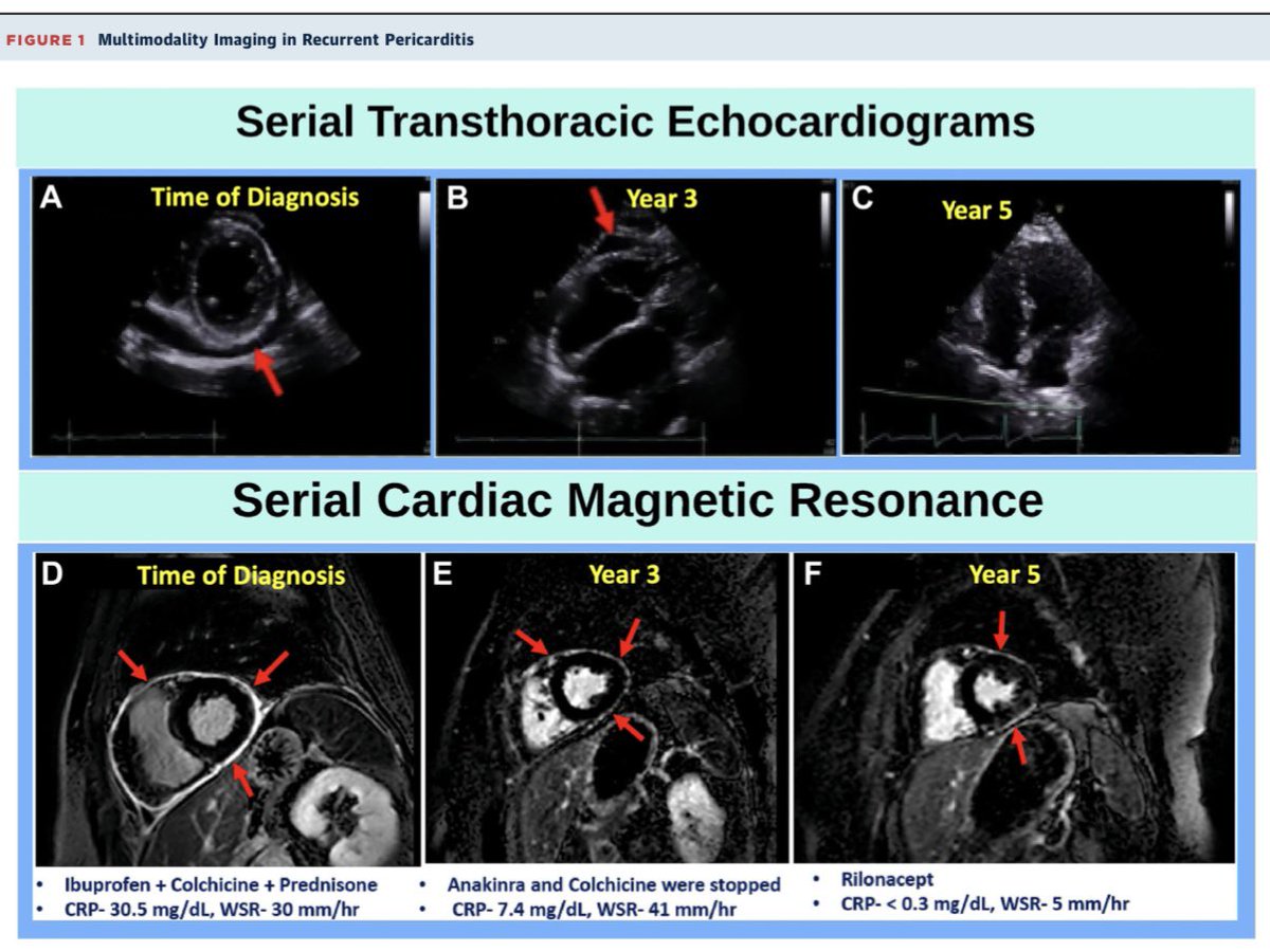 Muhammad Majid (@docmajid) on Twitter photo Excited to share our clinical vignette on the role of multimodality imaging in recurrent pericarditis, now published in <a href="/JACCJournals/">JACC Journals</a>. Huge thanks to my fantastic mentor Dr. <a href="/AllanLKleinMD1/">Allan L. Klein</a> for his invaluable support and mentorship. <a href="/AkivaRosenzveig/">Akiva Rosenzveig</a> <a href="/CleClinicHVTI/">Cleveland Clinic Heart, Vascular & Thoracic</a> Excited to share our clinical vignette on the role of multimodality imaging in recurrent pericarditis, now published in <a href="/JACCJournals/">JACC Journals</a>. Huge thanks to my fantastic mentor Dr. <a href="/AllanLKleinMD1/">Allan L. Klein</a> for his invaluable support and mentorship. <a href="/AkivaRosenzveig/">Akiva Rosenzveig</a> <a href="/CleClinicHVTI/">Cleveland Clinic Heart, Vascular & Thoracic</a>