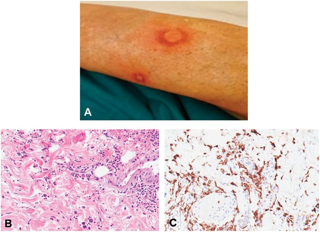 AJDP_Journal's tweet photo. #ClinicalPathologicChallenge
submitted by @gerardo_cazzato
78F p/w
(A) itchy and painful erythematosus patches on the legs
(B) Histiocytes engulfing neutrophilic granulocytes in karyorrhexis, lymphocytes, and erythrocytes
(C) IHC - CD163
What's your diagnosis? https://t.co/ab249B5KPp