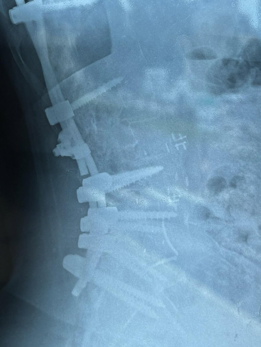 Bah voilà la poisse continue une tige de mon arthrodèse a cassée je douille au plus haut point je vis dans mon lit depuis 15 jours je vais devoir subir ma euh 10 eme operation pour cette satanée scoliose le sors s’acharne sur moi 😭 si vous avez la santé sérieux bénissez le ciel