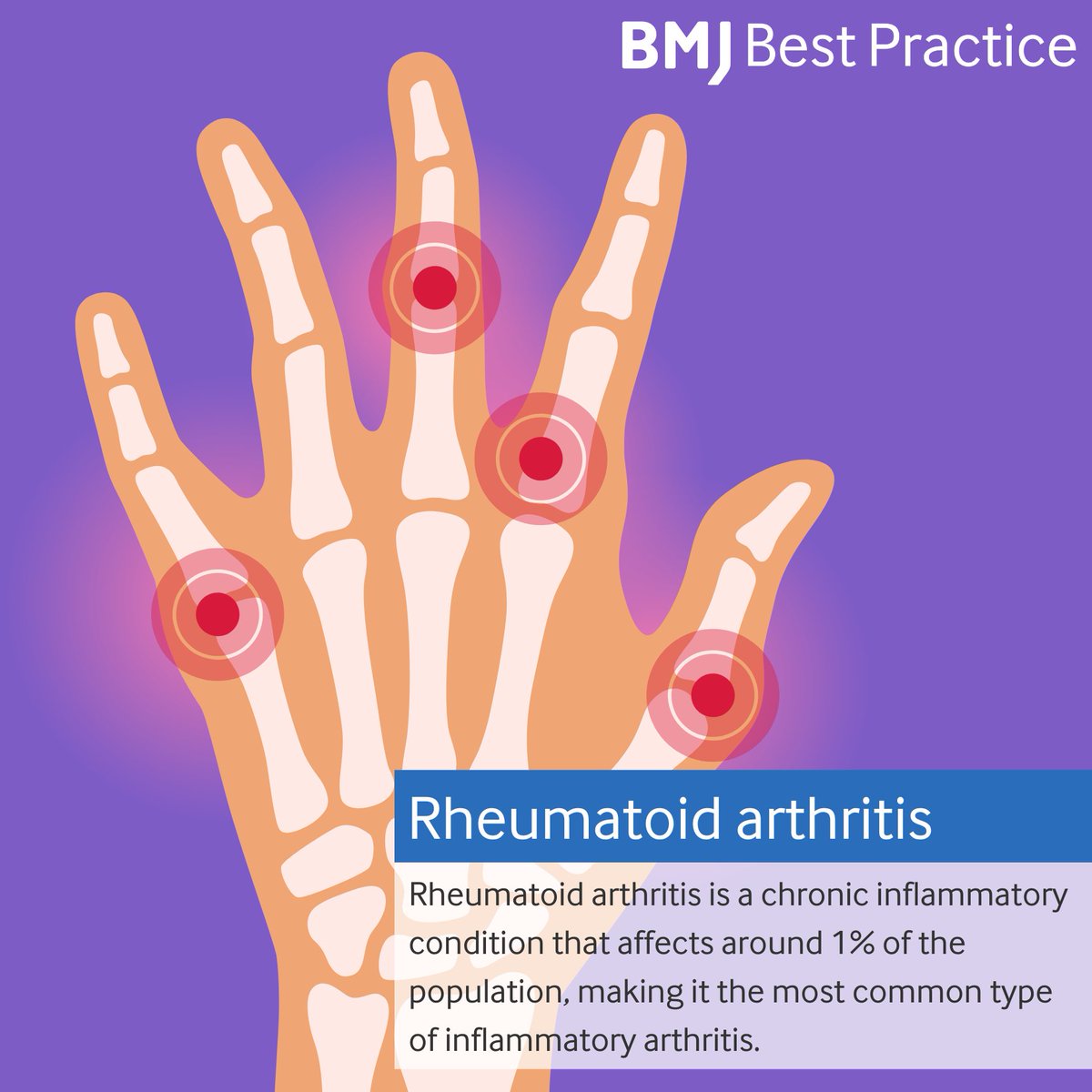 Rheumatoid arthritis is a chronic condition affecting 1% of the population, mainly targeting small joints in the hands and feet 🖐️🦶
Early treatment with DMARDs is key to preventing pain and joint damage 💡💊 

Learn more about rheumatoid arthritis: bestpractice.bmj.com/topics/en-us/1…