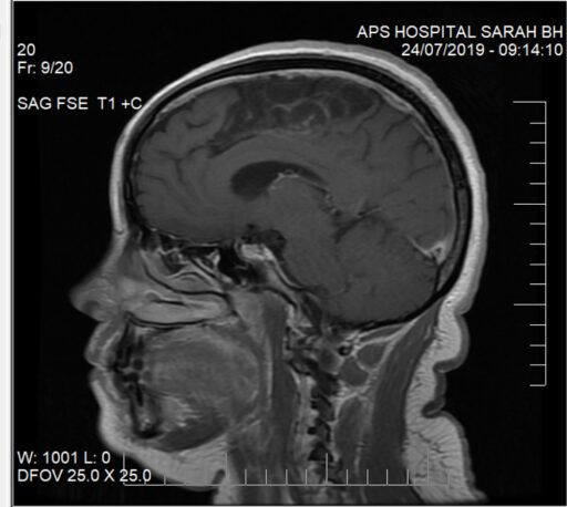 Reading and writing from right to left after anterior cerebral artery stroke. fou8.short.gy/LjpjRq