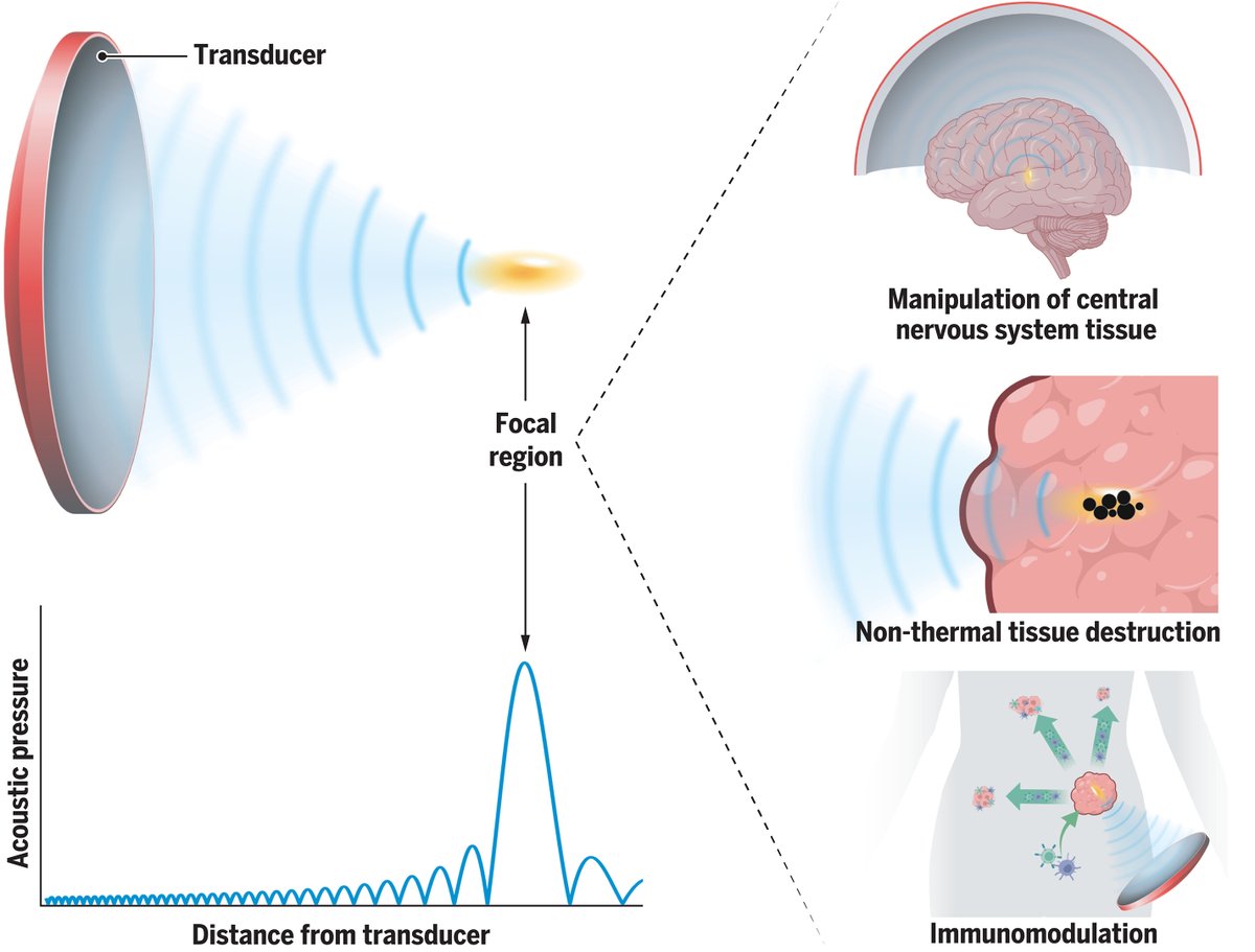 ScienceMagazine's tweet image. The most widely known application of ultrasound is for diagnosis, such as in prenatal care, but that is far from the only possible use for this versatile technology.

A new #ScienceReview takes a look at recent advances in the clinical applications of focused ultrasound for…