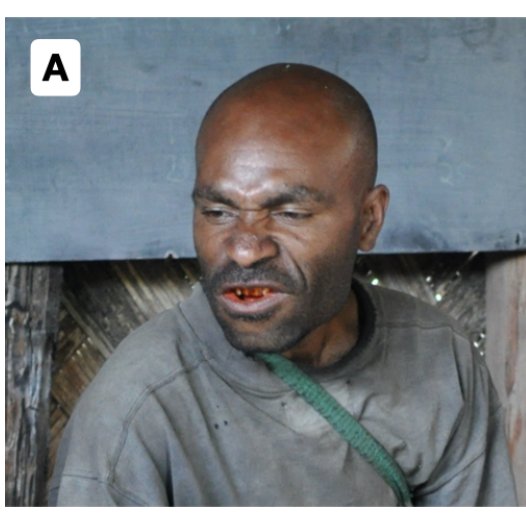 kensycoop's tweet image. New preprint!! 📣📣
A review of gesture in New Guinea, covering: pointing, emblems, time gestures, body count systems, and facial expressions.
The region remains woefully under-documented, but there are still plenty of intriguing observations.
osf.io/preprints/psya…