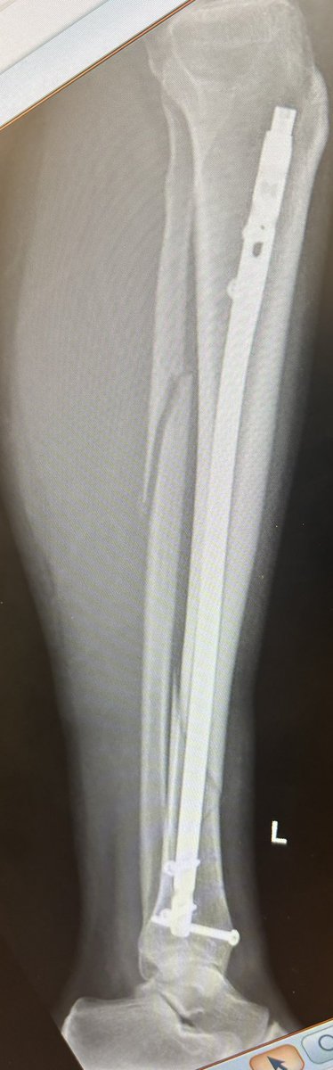 5 week check up. 

They are happy with my mobility and how it’s progressing. 

Consultant says not to do more than 30 mins without it being elevated so not allowed back to work yet. 

Sofa bound 😡

Anyone recommend some sort of sofa desk?? The pillow is driving me bonkers.