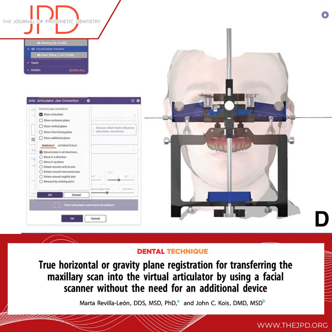 JPDentistry's tweet image. Check out this #dentaltechnique article that shows the step-by-step process of aligning and capturing the natural head position with a facial scanner without need for a #facebow or additional devices: thejpd.org/article/S0022-…