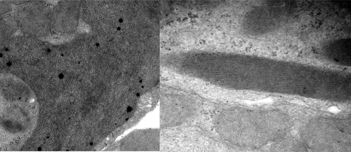 Well masked case of Light chain proximal tubulopathy in the setting of marginal zone lymphoma. Kappa light chains only visible follow pronase digestion. Completely invisible on LM and IF-frozen. Patchy membrane bound crystals by EM. #renalpath #nephrology #pathtwitter