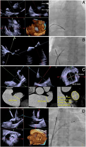 REC Publications (@revespcardiol) on Twitter photo Four-dimensional intracardiac echocardiography-guided appendage occlusion. #REC #AheadOfPrint <a href="/ChelhJamhour/">Karim Jamhour Chelh</a> <a href="/icsMillan/">Xavier Millán</a> <a href="/StructuralBCN/">Dabit Arzamendi</a> ow.ly/Yb5750TnLE7 Four-dimensional intracardiac echocardiography-guided appendage occlusion. #REC #AheadOfPrint <a href="/ChelhJamhour/">Karim Jamhour Chelh</a> <a href="/icsMillan/">Xavier Millán</a> <a href="/StructuralBCN/">Dabit Arzamendi</a> ow.ly/Yb5750TnLE7