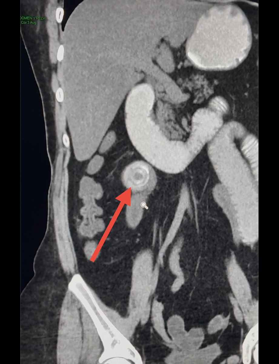 anhanssen's tweet photo. Not very frequent today (last case about 20 y ago), Bartholino syndrome (GallStone Ileus) #SoMe4Surgery @Cirbosque @Cirugiaunilibre @UnimetroCO @SAGES_Updates @Some4SurgeryIT1 @futuroscirascol https://t.co/zJLILZIDTh