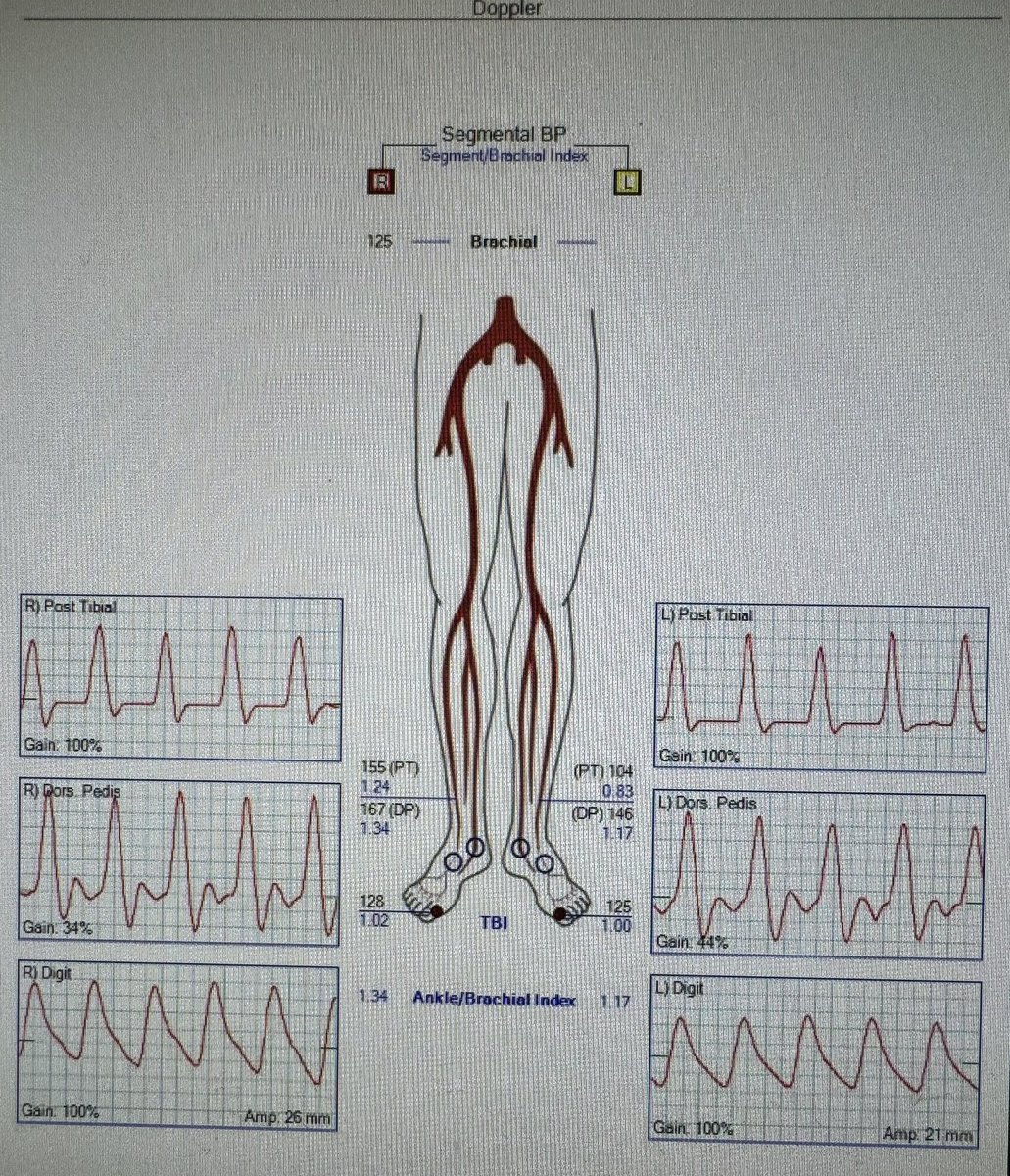 This patient was referred to me for a second opinion. He has been getting q3mo angiograms x2 years via pedal access for #PAD. He wanted to know if he could delay the next one without losing his leg.

Documented indication for angio: ESKD.

What are we doing?! 

#WeCanDoBetter