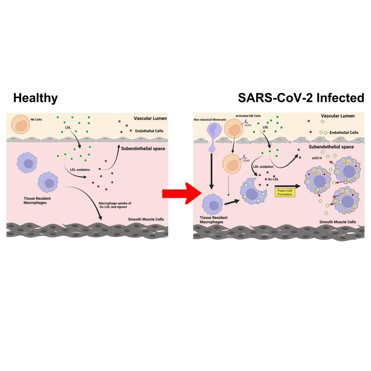 ATVB: An AHA Journal (@atvbahajournals) on Twitter photo Oct. Featured Article: The authors provide novel insights into how NK and Monocytes impact Ox-LDL metabolism during severe COVID-19, increasing cardiovascular disease risks 
ahajrnls.org/3Y8ghHD Oct. Featured Article: The authors provide novel insights into how NK and Monocytes impact Ox-LDL metabolism during severe COVID-19, increasing cardiovascular disease risks 
ahajrnls.org/3Y8ghHD