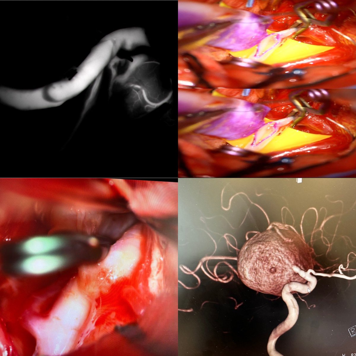 Dr Amir R. Dehdashti (@amirdehdashti) on Twitter photo Join us at T14 lunch seminars today to hear all about aneurysm surgery #CNS2024 <a href="/cvsection/">CV Section</a> <a href="/CNS_Update/">CNS</a> <a href="/NeurosurgeryCNS/">Neurosurgery Publications</a>
Will give a lecture on management of intra-operative unexpected complications Join us at T14 lunch seminars today to hear all about aneurysm surgery #CNS2024 <a href="/cvsection/">CV Section</a> <a href="/CNS_Update/">CNS</a> <a href="/NeurosurgeryCNS/">Neurosurgery Publications</a>
Will give a lecture on management of intra-operative unexpected complications