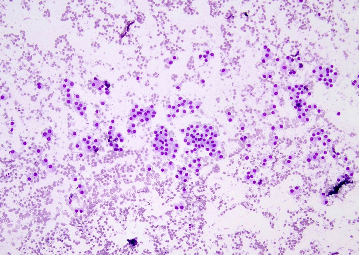 CuringN's tweet photo. Salivary glands - What's your diagnosis?
Topic link: https://t.co/Lx87kVpeok
Images contributed by Arash H. Lahouti, M.D. and Rema A. Rao, M.D.
#Cancer #CancerResearch #CuringCancerNetwork #Pathology https://t.co/SeVraxFBiH