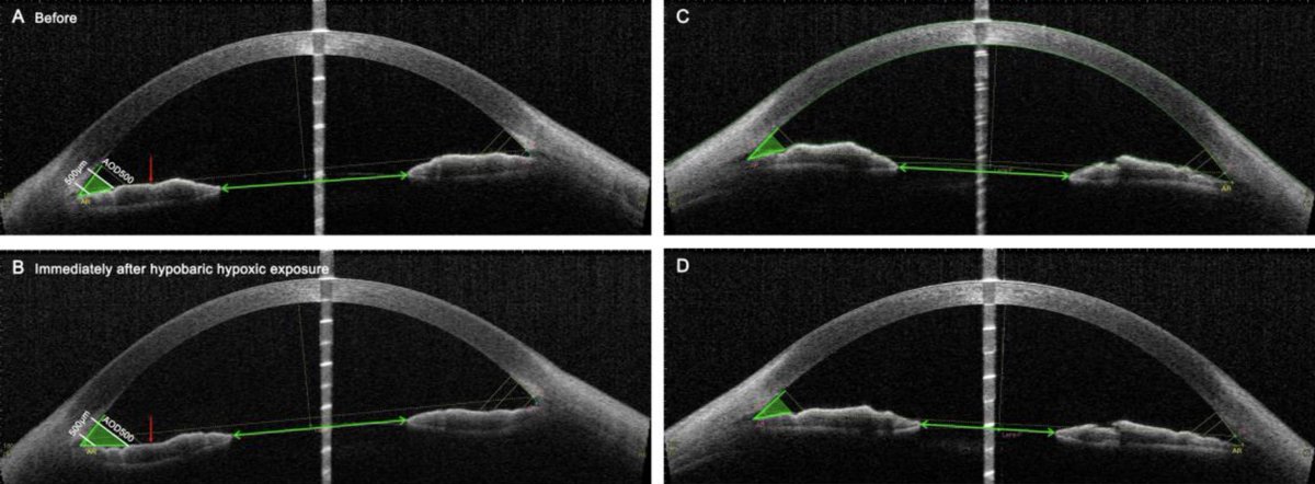 revoptom's tweet image. Pupils Constrict at High Altitudes, Study Finds
Short-term exposure also led to decreased iris curvature and widened angle opening distance, trabecular-iris space area and angle recess area.

Read more: reviewofoptometry.com/article/pupils…

#optometry #cornea #altitude