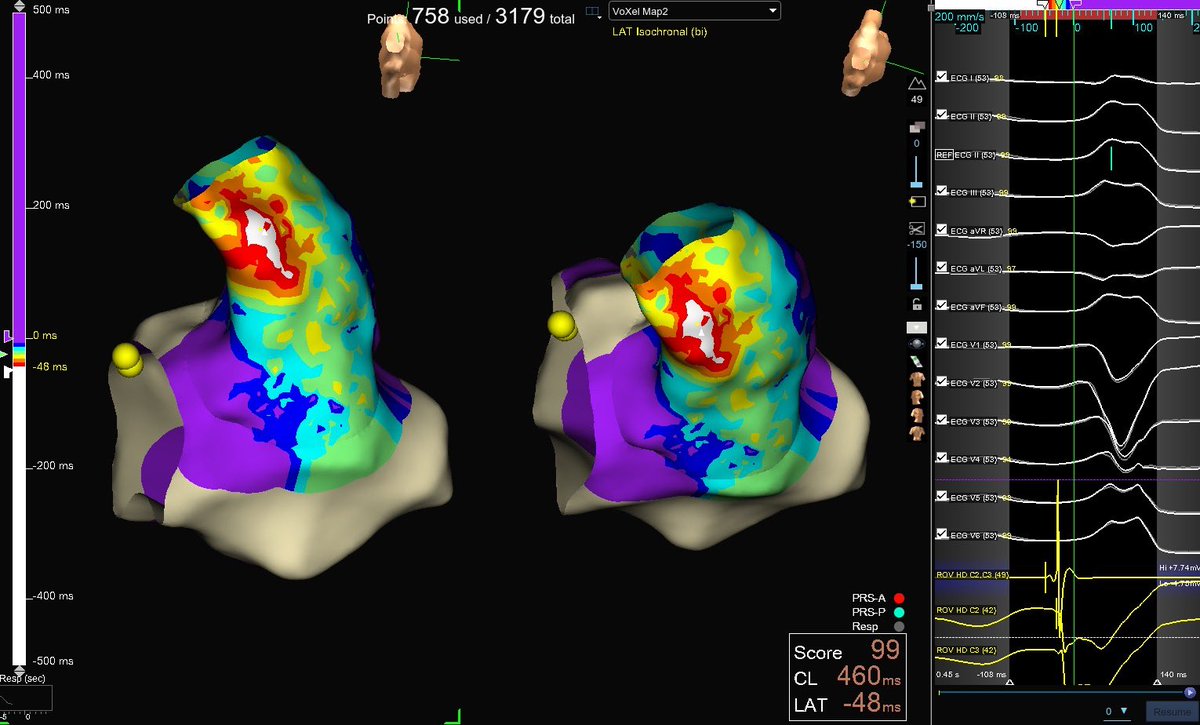 FergieLosiniec1's tweet image. Nice case with @AbbottCardio @Mapbastian @mhshospital #EPeeps #WIC #WomenInEp #AblateVT. Thank you to @JRWinterfield @MUSC_EP @AMatthews0 for the lessons learned! Makes for a nice day in the office.