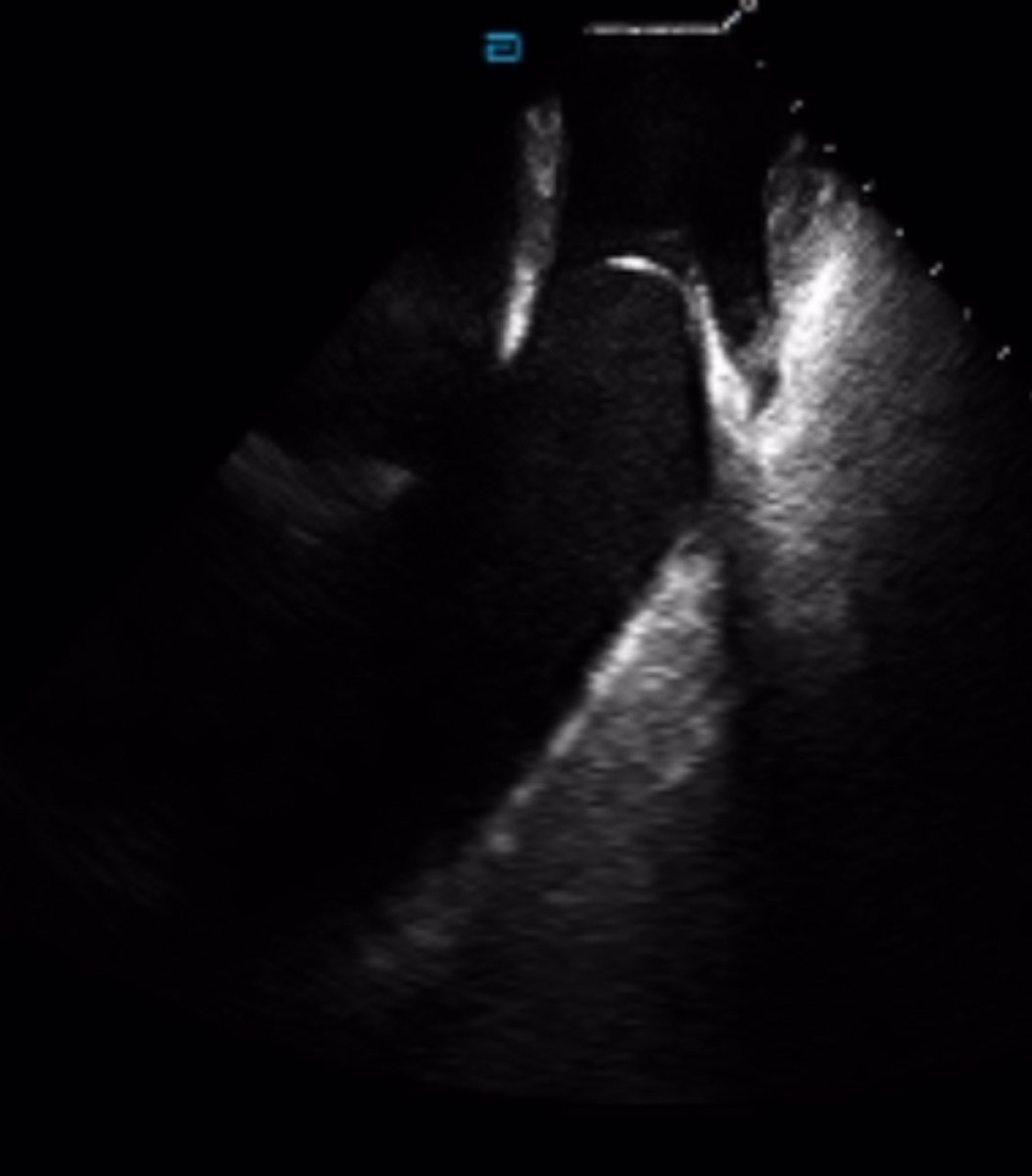FergieLosiniec1's tweet image. Nice case with @AbbottCardio @Mapbastian @mhshospital #EPeeps #WIC #WomenInEp #AblateVT. Thank you to @JRWinterfield @MUSC_EP @AMatthews0 for the lessons learned! Makes for a nice day in the office.