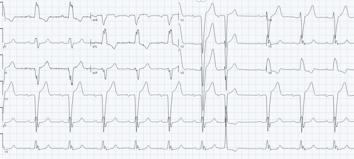 Gregory Michaud (@drgregmichaud) on Twitter photo #Epeeps and #EPFELLOWS. Pre and Post TAVR ECGs discovered by <a href="/tung_patricia/">Patricia Tung</a> during a reading day. What's up with the premature beat? #Epeeps and #EPFELLOWS. Pre and Post TAVR ECGs discovered by <a href="/tung_patricia/">Patricia Tung</a> during a reading day. What's up with the premature beat?