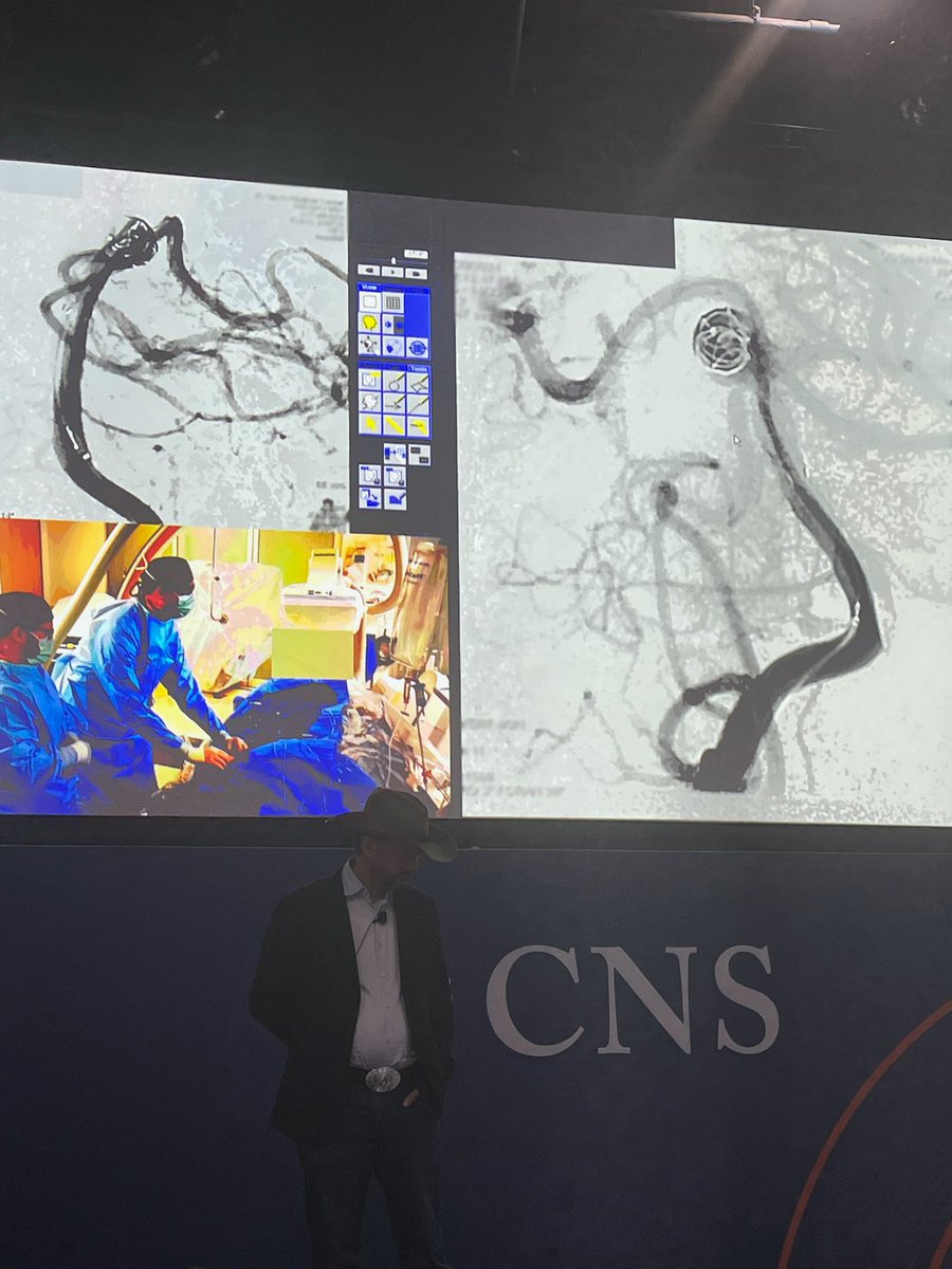 At yesterday's #CNS2024 live case presentation, Ben Waldau, M.D., and fellow Clayton Gerndt, M.D., performed a complex aneurysm coiling procedure. Branden Cord, M.D., Ph.D., shared insights from the stage in Houston as neurosurgeons nationwide learned from the case in real time.