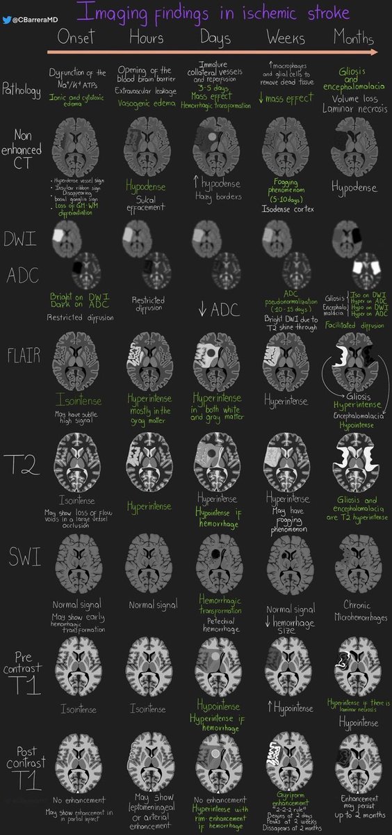 Imaging findings in ischemic stroke <a href="/CBarreraMD/">Christian Barrera, MD</a> #MedEd
