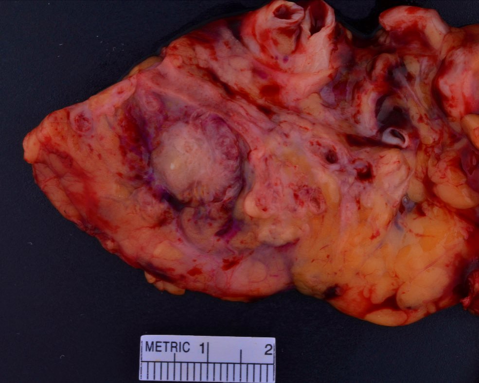 Pancreatic “ductal” adenocarcinoma is often not one of the most photogenic tumors, one of its many frustrating qualities (although far from its worst quality), but thanks <a href="/MayoClinicPath/">Mayo Clinic Pathology</a> PA for getting the perfect slice as makes good teaching case of what a bd-IPMN associated