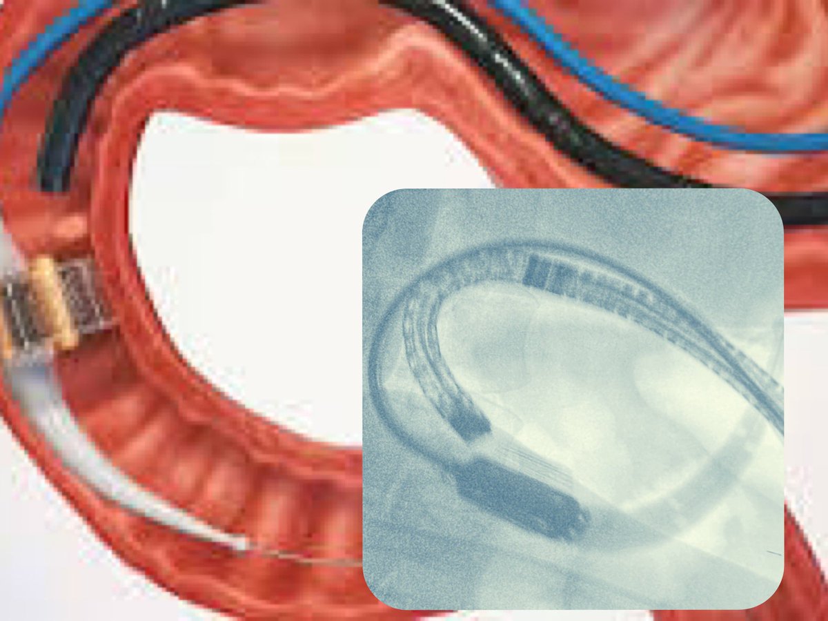 Manoel Galvao Neto MD, MSC, FASGE, IFASBMS tweet media