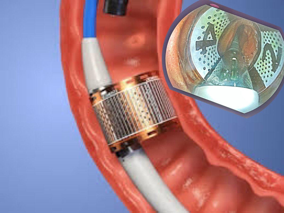 Manoel Galvao Neto MD, MSC, FASGE, IFASBMS tweet media