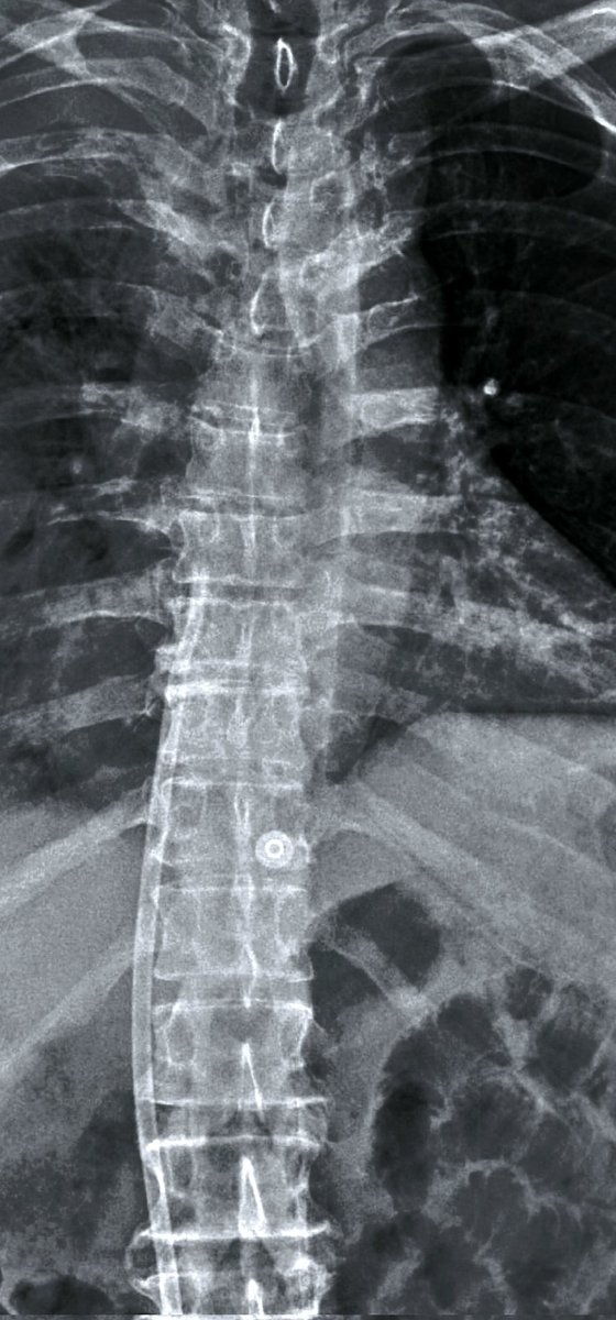 AvelRomanNeph's tweet photo. femoral tunneled catheter
#Interventionalnephrology #INfellow #HDcatheter https://t.co/Dg94SMbQkH