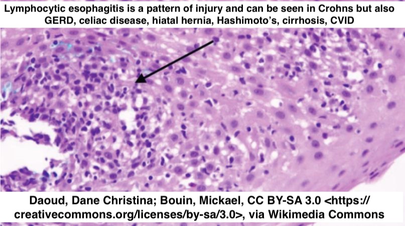 📖Esophagus in Crohn Disease

🔵 Usually ass w advanced ileo-colonic dz
🔴 Histologic abnormalities may not correlate with endoscopic finding of nml mucosa
🔬 May see granulomas
🔬 May see lymphocytic esophagitis pattern (NOT specific)
⚠️ Keep in back of your mind

#pathx #gipath